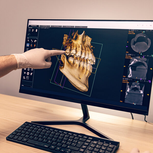 3D CBCT scan | Dental Cone-Beam Computed Tomography | San Diego Smile Pros